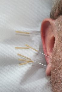 Akupunkturnadeln in einem Ohr, Stichwort Ohrenschmerzen. (c) Pixabay.com