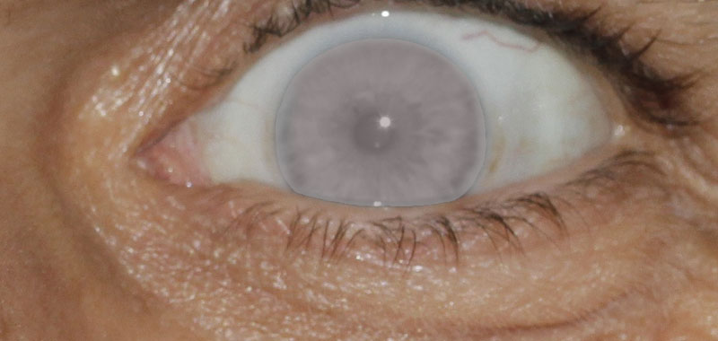 Pupille mit grauem Schleier. (c) Pixabay.com