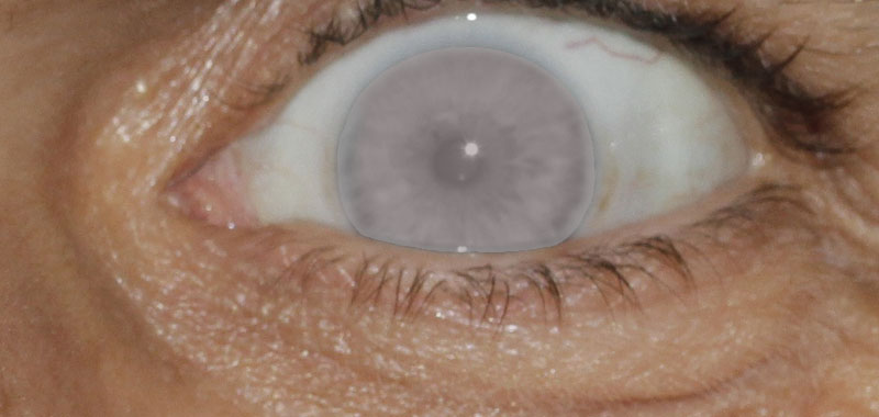 #Sehgesundheit: Grauer Star – Anzeichen, Ursachen, Therapien. 2 Pupille mit grauem Schleier. (c) Pixabay.com