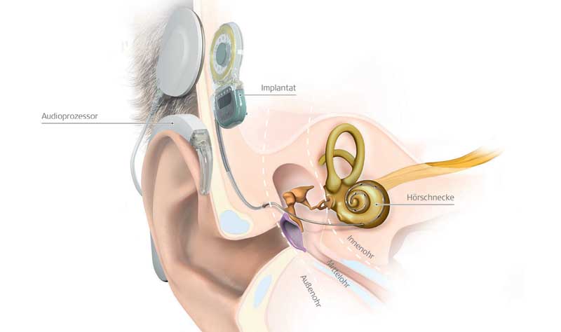 Darstellung eines Hörimplantats als Methode gegen Hörverlust. (c) MED-EL