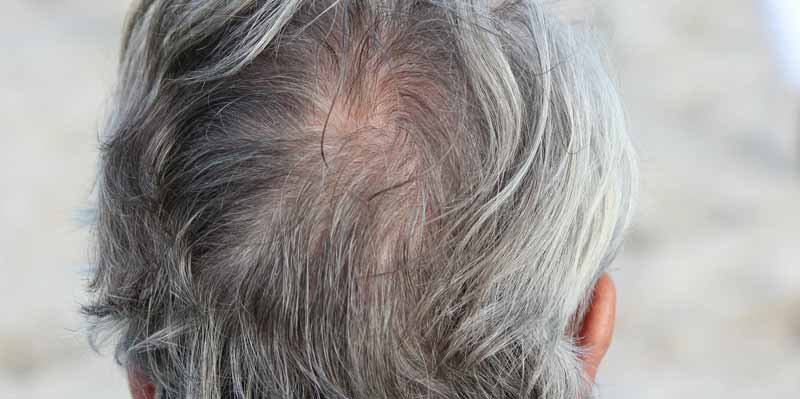 Probleme mit Haarausfall: Wieviel ist normal? Ab wann ist es zu viel? 2 Der Hinterkopf einer älteren Person mit grauen Haaren und einer leicht kahlen Stelle. (c) Pixabay.com