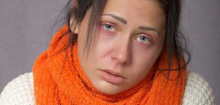 Das Gesicht einer Frau mit einer starken Erkältung. (c) Pixabay.com