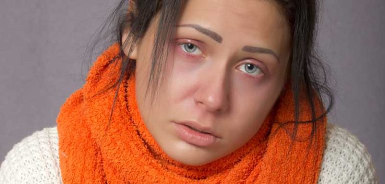 Das Gesicht einer Frau mit einer starken Erkältung. (c) Pixabay.com