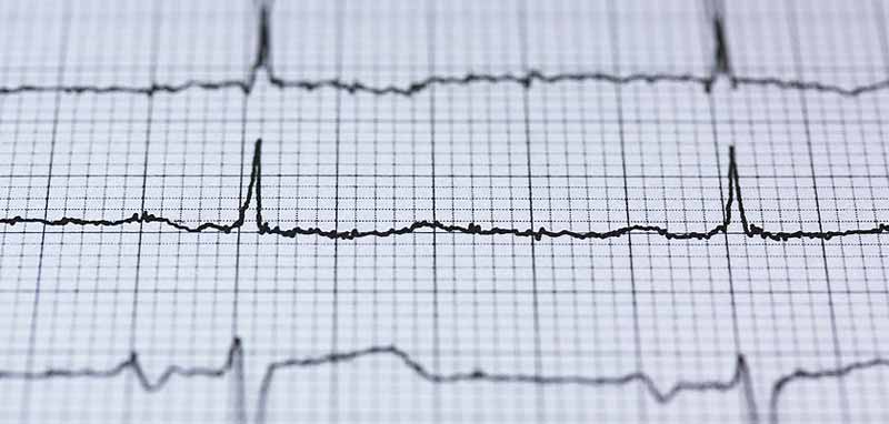 EKG-Diagramm. (c) Pixabay.com