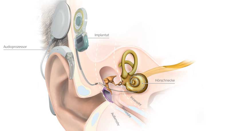 Infografik: Ohranatomie mit Cochleaimplantat. (c) MED-EL