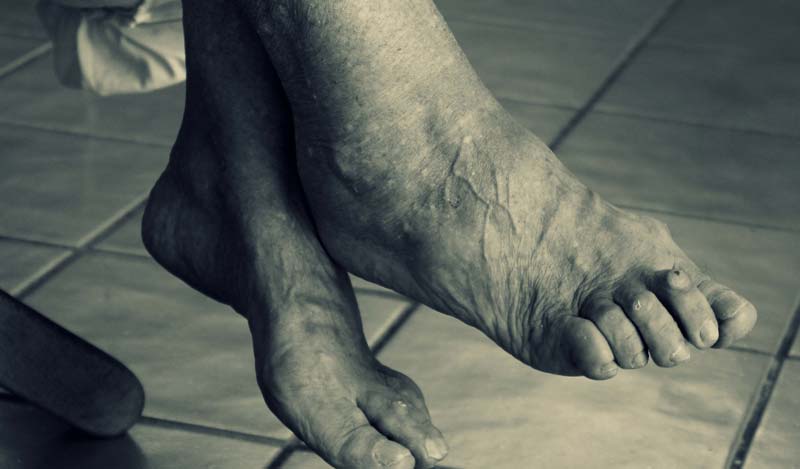 Die Füße einer alten Frau, Stichwort Krampfadern.
(c) Pixabay.com
