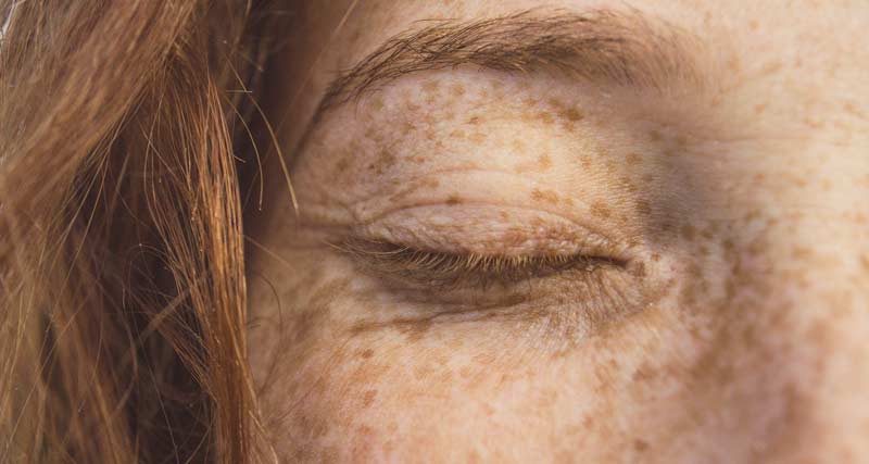 "Sonne ohne Reue" – auf die Hautkrebsvorsorge nicht vergessen! 2 Ausschnitt des Gesichts einer Frau mit vielen Sommersprossen.
(c) Pixabay.com