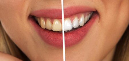 Das Lächeln einer Frau, eine Hälfte mit dunklen Zähnen, eine mit strahlend weißen. (c) Pixabay.com