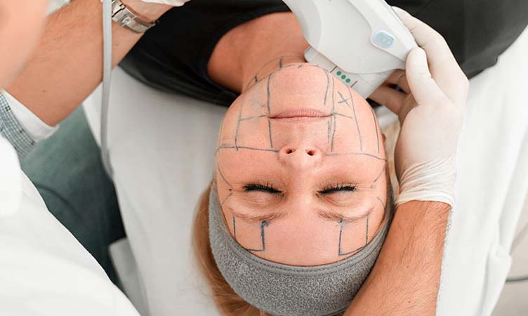 Das Gesicht einer Frau, die mit Ultherapy behandelt wird.
(c) OmniMed