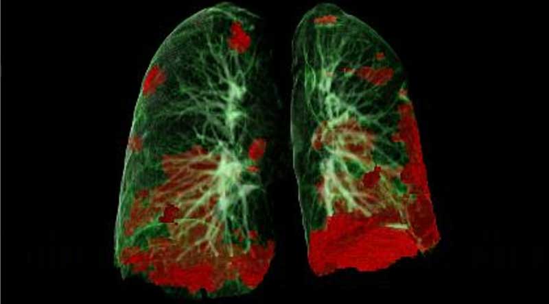 Röntgenbild einer von Corona-Viren befallenen Lunge.
(c) Radiologie Innsbruck