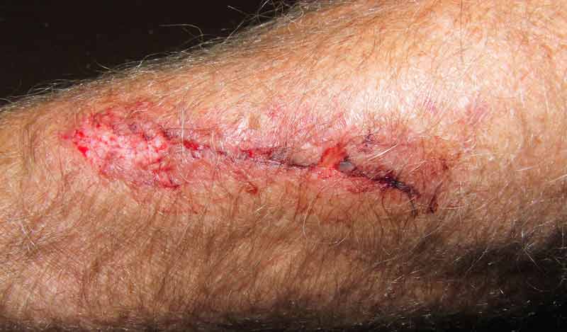 Ein Arm mit einer Schnittwunde, Stichwort Sepsis.
(c) Pixabay.com