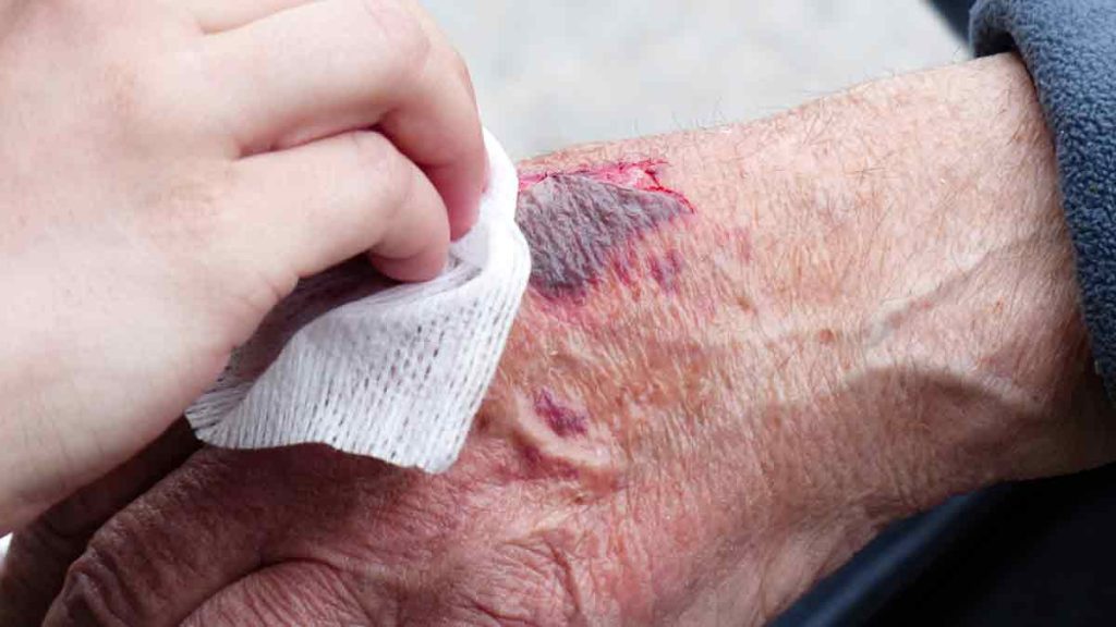 Eine Hand, die eine Schürfwunde auf der Hand einer alten Person reinigt. (c) Pixabay.com