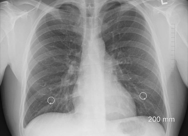 Das Röntgenbild einer menschlichen Lunge, Stichwort Lungenkrebs.
(c) Pixabay.com