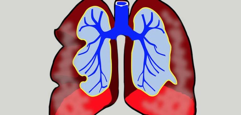 Illustration einer menschlichen Lunge. (c) Pixabay.com