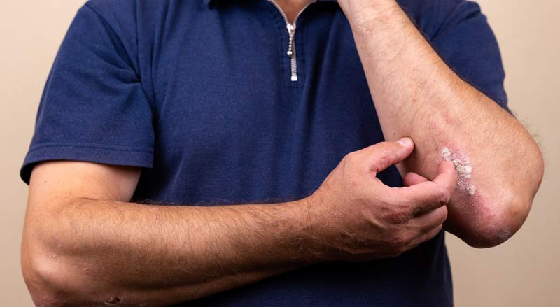 Die Hände eines Mannes, der sich am Ellbogen an einer Schuppenflechte kratzt, Stichwort Neurodermitis.
(c) AdobeStock