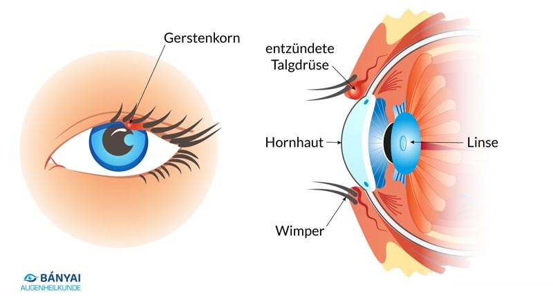 Grafik: Gerstenkorn an einem Augenlid sowie anatomische Darstellung eines Auges.
(c) Banyai Augenheilkunde
