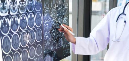 Die Hand einer Ärztin, die mit einem Stift auf Röntgenbilder eines Gehirns zeigt. (c) AdobeStock