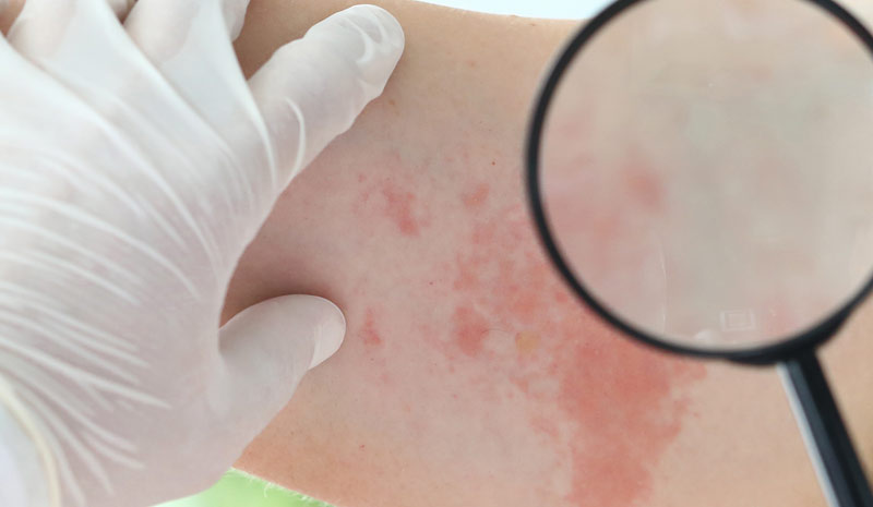 "Int. Gesundheitswoche Gürtelrose" – Information und Aufklärung 1 Jemand schaut sich einen Hautausschlag mit einer Lupe an, Stichwort Gürtelrose.
(c) AdobeStock