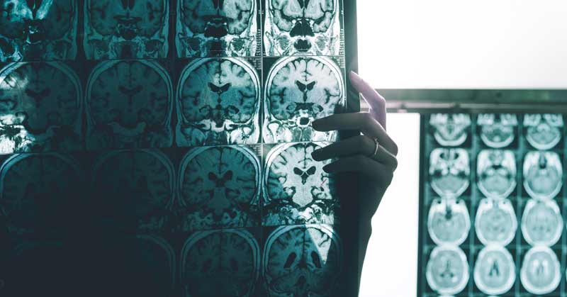 Die Hand einer Frau, die sich Röntgenbilder eines Gehirns anschaut.
(c) AdobeStock