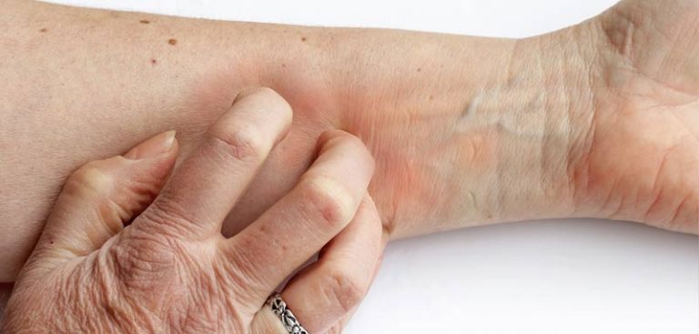 Die Hand einer älteren Frau, die sich am Unterarm kratzt. (c) AdobeStock