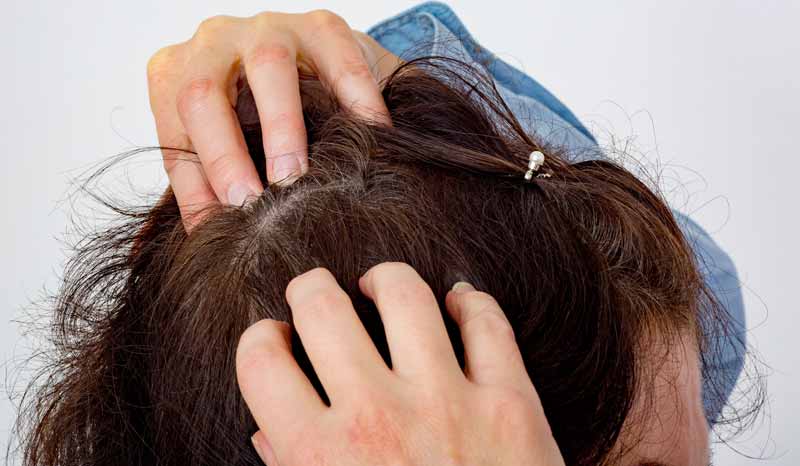 Neurodermitis: 5 Mythen über diese Hauterkrankung im Faktencheck 2 Der Kopf einer Frau, die sich mit den Händen die Kopfhaut kratzt.
(c) AdobeStock
