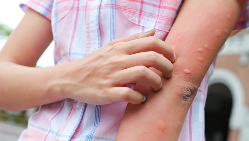 Asiatische Tigermücke im Vorjahr erstmals im ganzen Land gefunden 1 Der Arm einer Frau, der von Gelsenstichen übersät ist, Stichwort Asiatische Tigermücke.
(c) AdobeStock