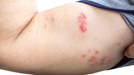 Der Oberarm eines Mannes mit einem Herpes Zoster Ausschlag. (c) AdobeStock