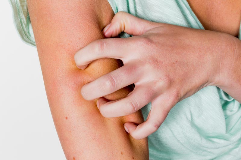 Neurodermitis im Sommer – die Badesaison wird zur Herausforderung 1 Die Hand einer Frau, die sich wegen Neurodermitis auf ihrem Oberarm kratzt.
(c) AdobeStock