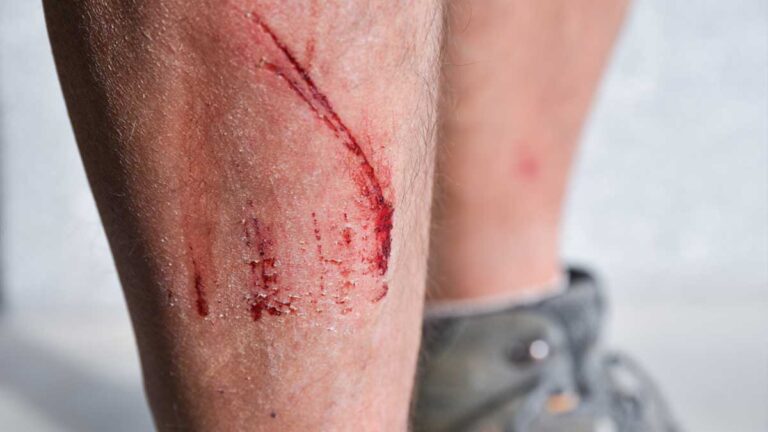 Das Bein eines Mannes mit leichten Kratzwunden. (c) AdobeStock