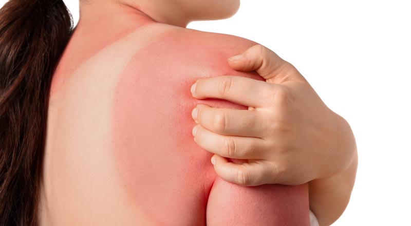 Hautgesundheit: Schmieren, meiden und kleiden – der gesunde Umgang mit Sommersonne 1 Der Rücken einer Frau mit Sonnenbrand.
(c) AdobeStock