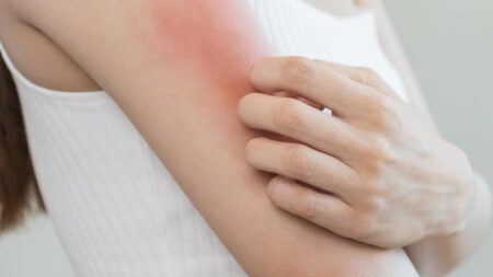 Der Oberarm einer Frau, die sich nach einem Insektenstich kratzt. (c) AdobeStock