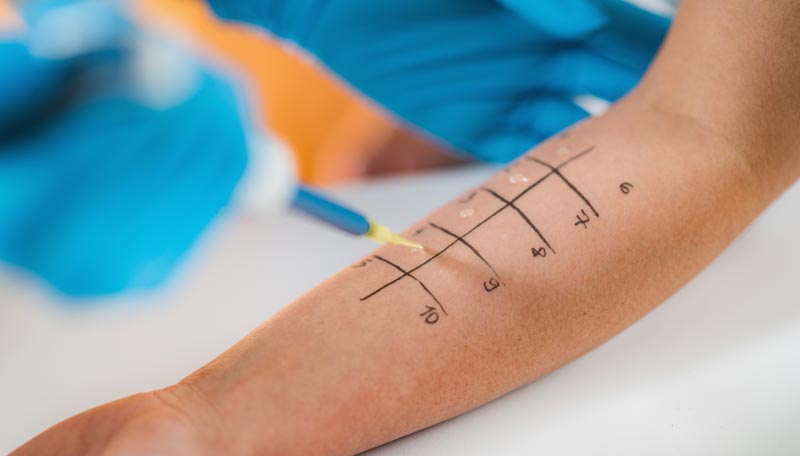Durchführung eines Prick-Tests am Unterarm zur Diagnose einer Pollenallergie in einer Arztpraxis, Stichwort Pollensaison 2026.
(c) AdobeStock
