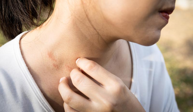 Eine Person in einem grauen T-Shirt kratzt sich intensiv am Unterarm, der deutliche Rötungen und Symptome eines Neurodermitis-Schubs zeigt.(c) AdobeStock