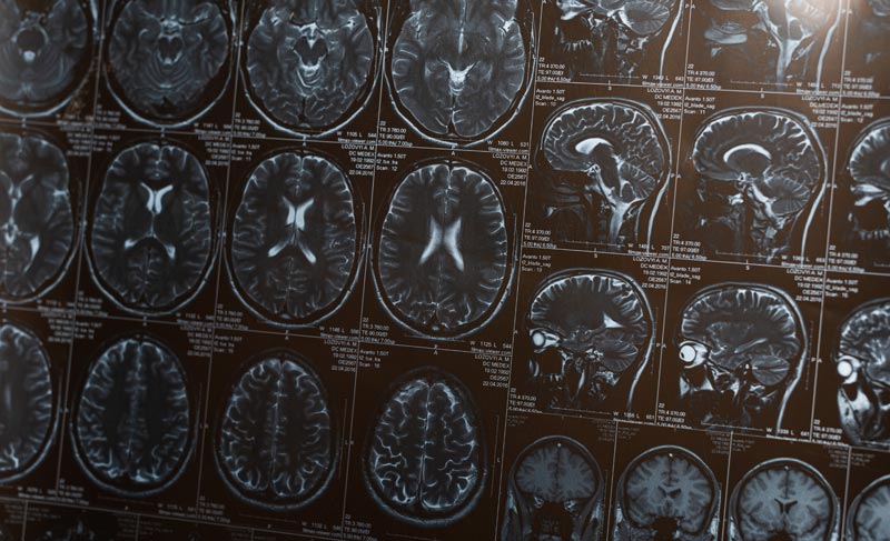Parkinson Therapie in Österreich: Der stille Durchbruch gegen den Kontrollverlust 2 Mehrere MRT-Aufnahmen (Magnetresonanztomographie) des menschlichen Gehirns in verschiedenen Schnittebenen (axial, sagittal) auf einem dunklen Leuchtkasten.
(c) AdobeStock