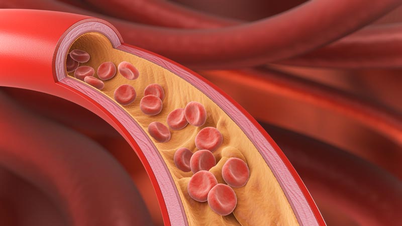 Medizinische Grafik einer Arterie im Querschnitt, die gelbe Plaque-Ablagerungen (Arteriosklerose) und rote Blutkörperchen zeigt.
(c) AdobeStock