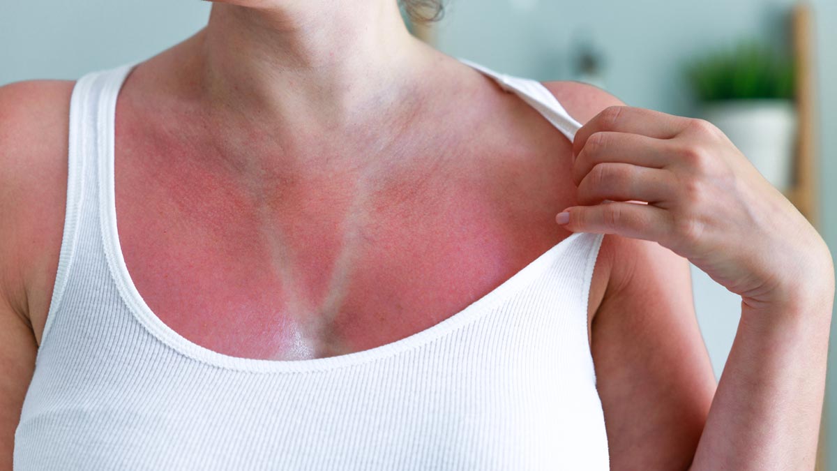 Sonnenschutz ab 50: Warum zwei Drittel im roten Bereich landen Starke Hautrötung und Sonnenbrand am Dekolletee einer Frau im weißen Top als Zeichen für UV-Schäden. (c) AdobeStock